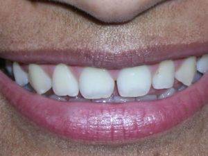 Porcelain veneers are a simple solution