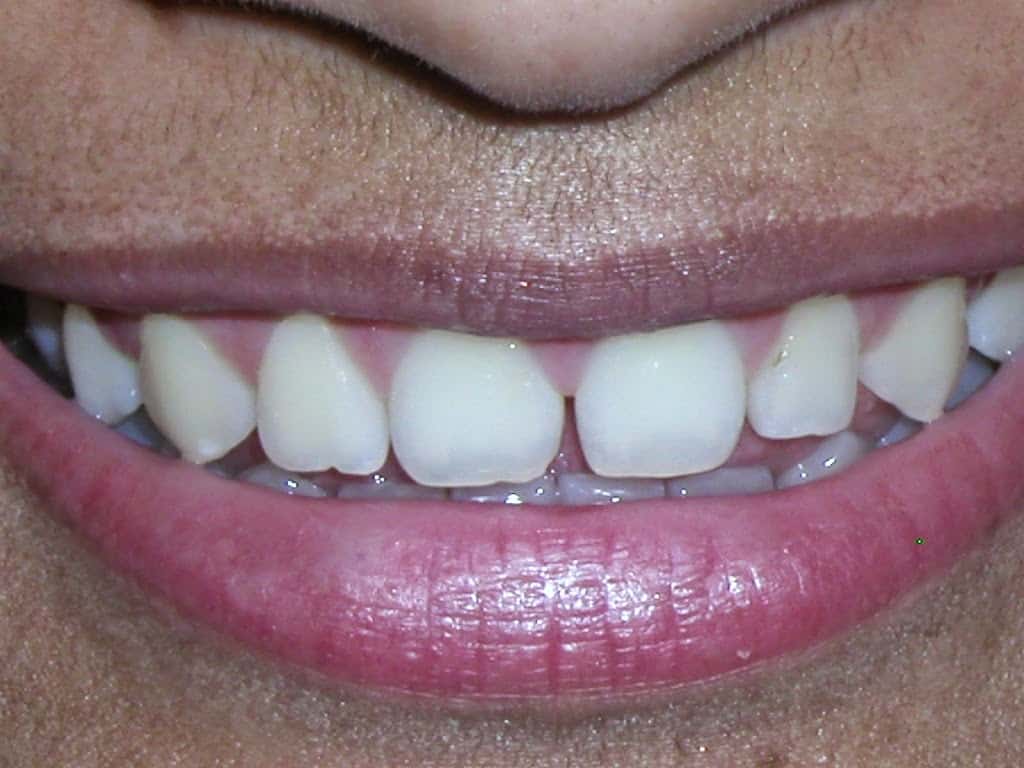 Give your Smile a Makeover: Look Younger with Porcelain Veneers