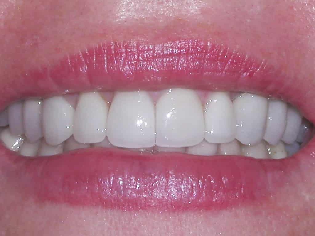 Why You Should Change Your Mercury Fillings to Biocompatible Resin?