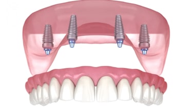 How Implants Improve Dentures