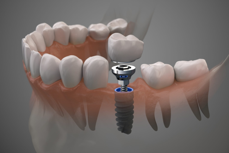 South Bay Dental implants- for Single Tooth Replacement