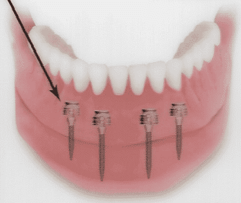 Why Dental Implants Are The Best Tooth Replacement Methods