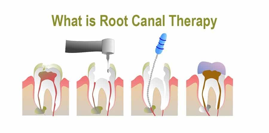 Understand Teeth, Their Conditions and Treatment- 10 What Is a Root Canal?