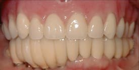 Dental Implant Before 3