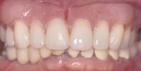 Dental Implant After 2