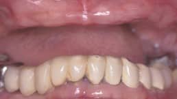 Dental Implant Before 2