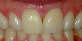 Dental Implant After 1