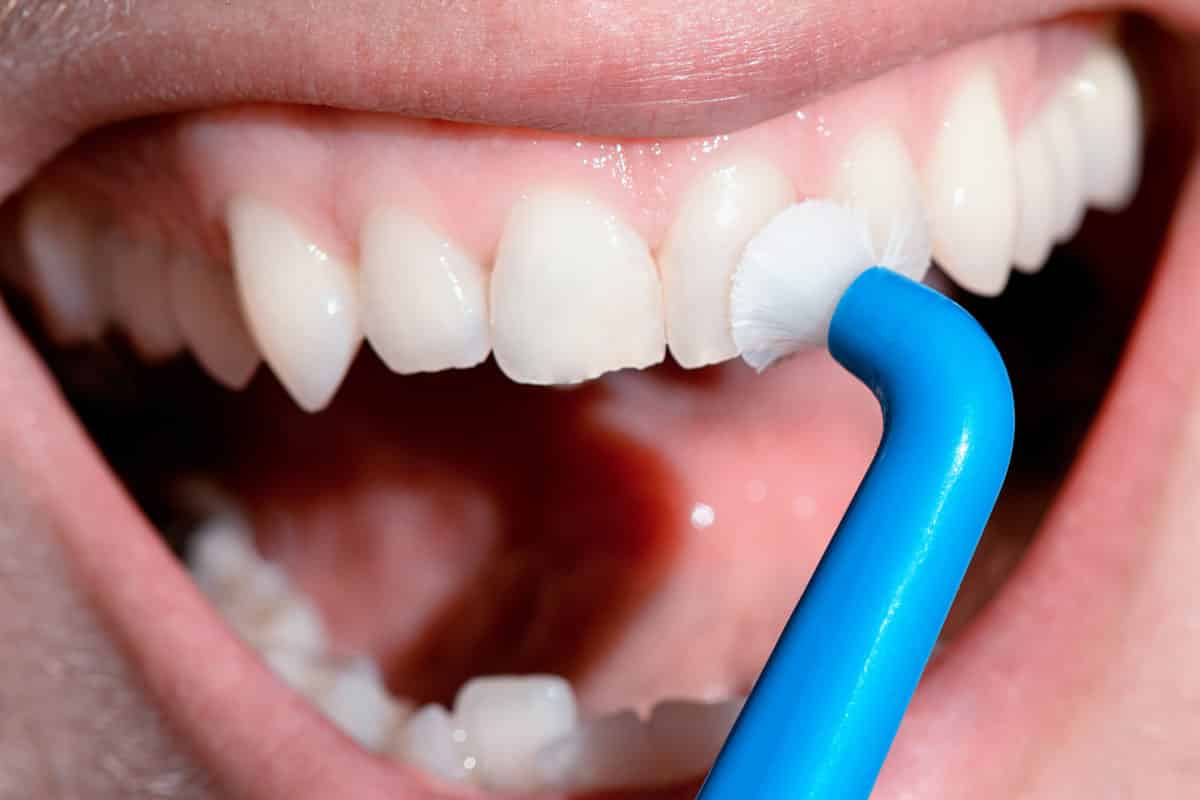Understand Teeth, Their Conditions and Treatment- 15 – What a Dental Cleaning Involves