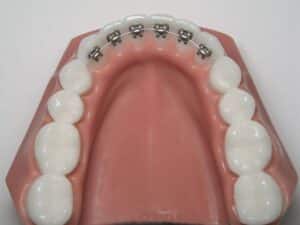 In-Ovation® L MTM braces
