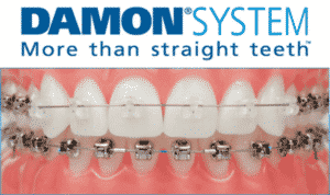 Damon System Braces