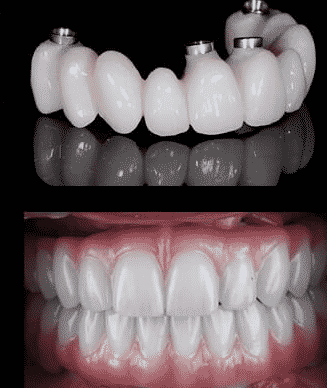 All-on-4 Full Mouth Dental Implants