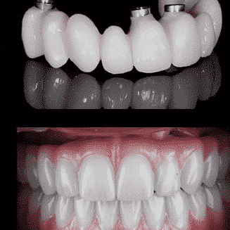 Understanding All-on-4 Dental Implants: Benefits, Procedure & More