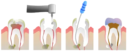 6 Symptoms that show you may need a root canal treatment