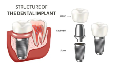 The structure of dental implants