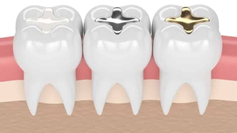 All You Need to Know About Cavities & Fillings