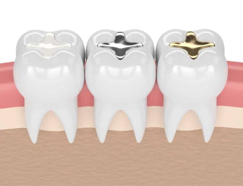 cavities and dental fillings