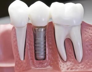 Why are dental implants so common these days