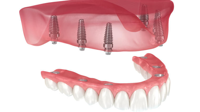 How To Choose The Right Dental Implant Specialist in Gardena