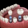 How Dental Implants Can Save You Money In The Long Term