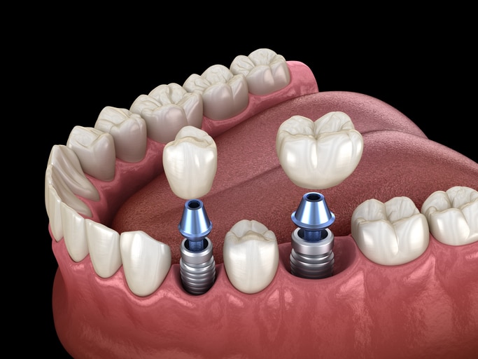 Dental Implants: Types of dental implants and procedures of dental implants