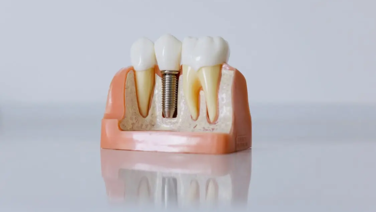 15 Innovations in Dental Implant and Their Materials