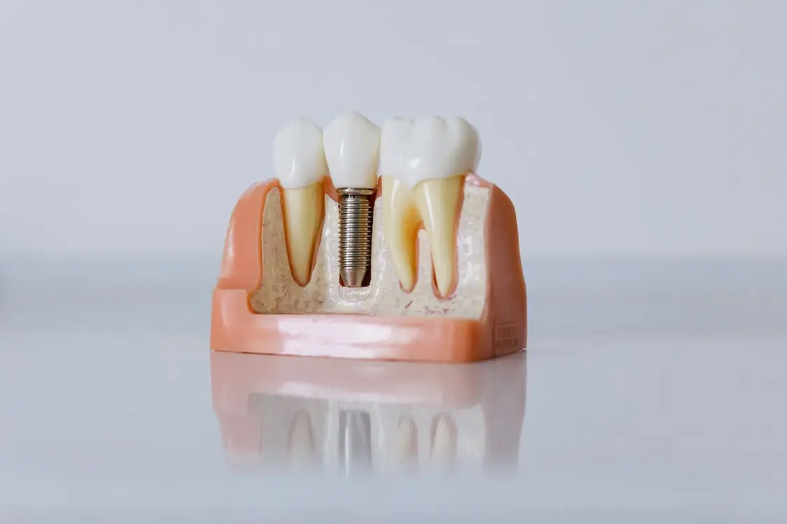 Dental Implants South Bay Dentist