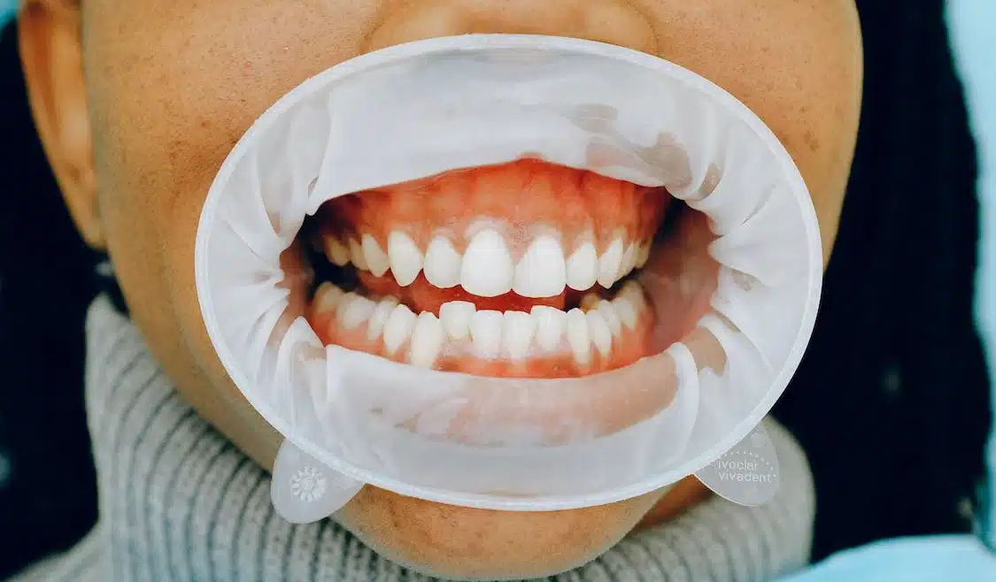Gum Disease: FAQs Answered by a Dentist