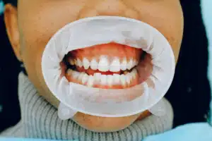 Gum Disease (periodontal disease)