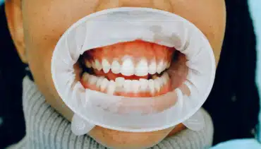 Gum Disease: FAQs Answered by a Dentist