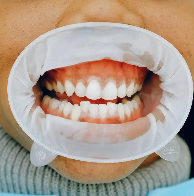 Gum Disease (periodontal disease)