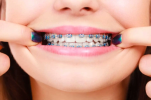 South Bay Dentistry Orthodontics Kids Braces