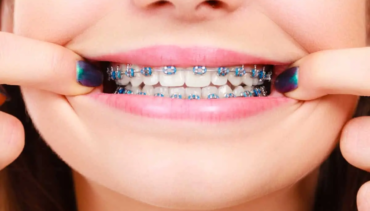 Invisalign vs. Traditional Braces: Choosing the Right Orthodontic Treatment