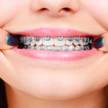 South Bay Dentistry Orthodontics Kids Braces