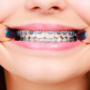 Invisalign vs. Traditional Braces: Choosing the Right Orthodontic Treatment