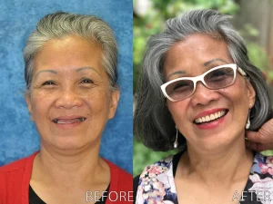 Before and After photo, Denture, Snap-On-Dentures on Implants from South Bay Dental Implants