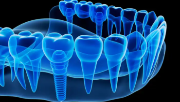 5 Steps that most dentists take to perform dental implants