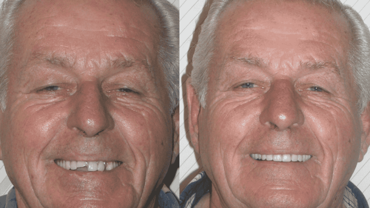 What’s involved with Getting a Dental Implant