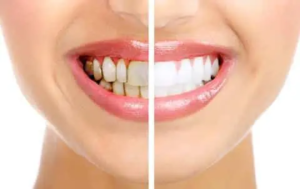Healthy beautiful smile. Dental health. Whitening