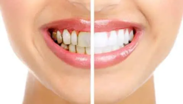 How to Achieve a Whiter Smile
