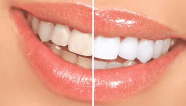 Importance of Teeth Whitening