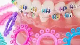 Colorful braces by South Bay Dentists