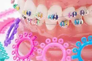 Colorful braces by South Bay Dentists