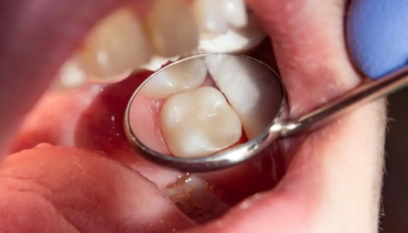 All You Need to Know About Cavities & Fillings
