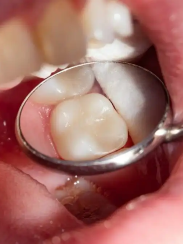 Dental composite fillings by South Bay Dentistry and Orthodontics