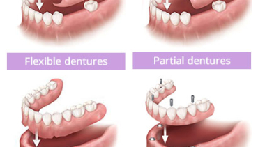 Reasons to choose dentures over implants
