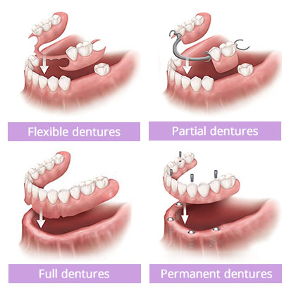 Reasons to choose dentures over implants