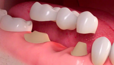 FAQs Related to Dental Bridges