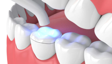 Inlay Restorations from South Bay Dentistry & Orthodontics