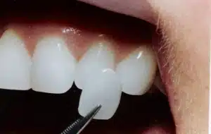 dental lumineers
