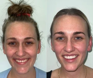 Smile Makeover at Green dental- Before & After